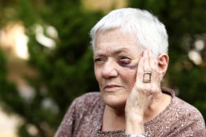 elderly woman with black eye holding hand to her eye